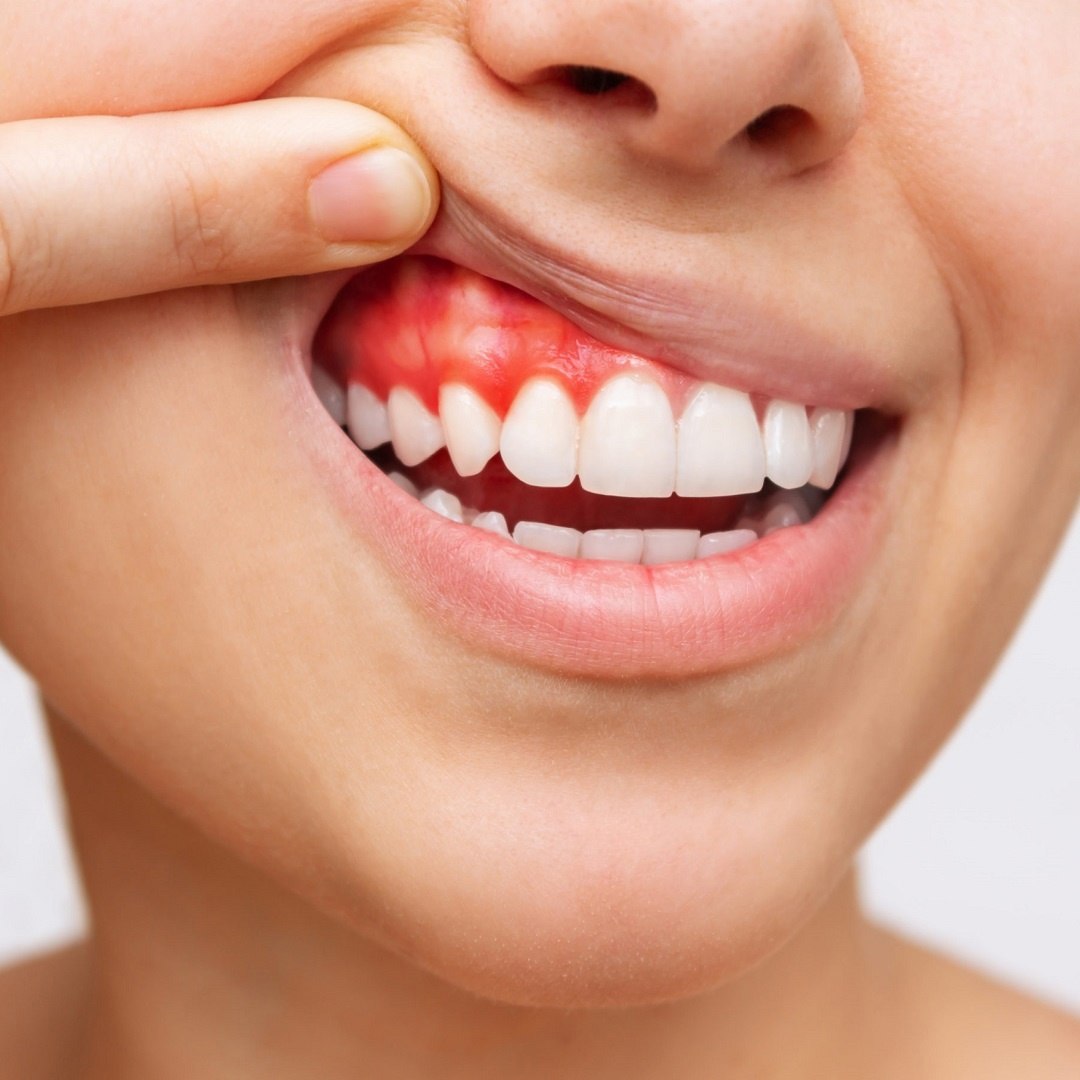 Lazerle Diş Eti Şekillendirme 7777